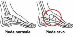 Clearance Solette Plantari per Correzione Piede Cavo - Scarpe Uomo e Donna Plantari