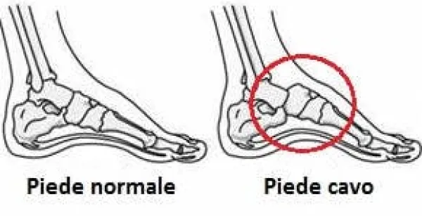 Clearance Solette Plantari per Correzione Piede Cavo - Scarpe Uomo e Donna Plantari